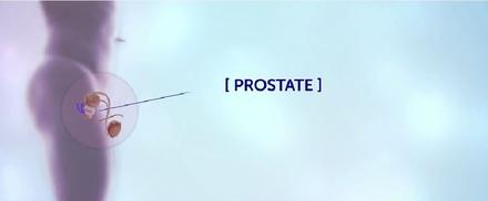Prostate cancer treatment support immagine di anteprima